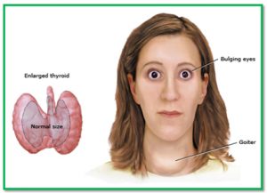 Thyrotoxicosis - UCLA-Olive View Internal Medicine